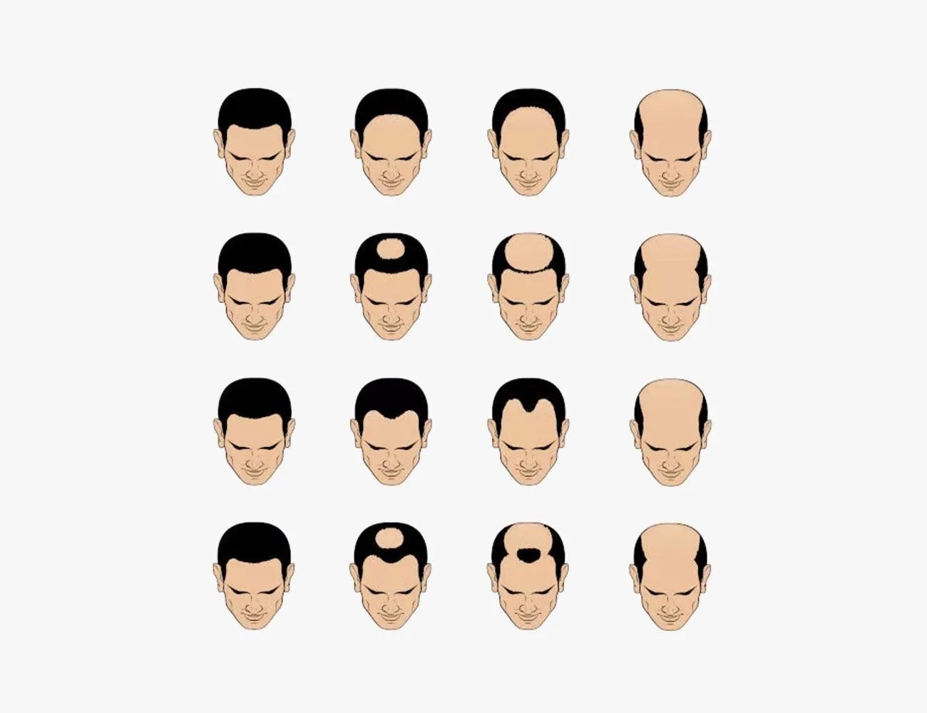 hair loss chart for men