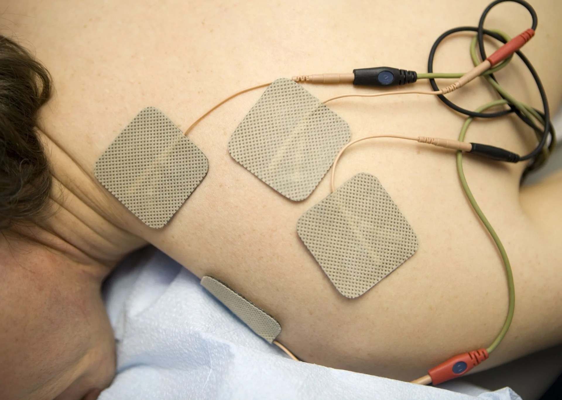 shoulder electrotherapy